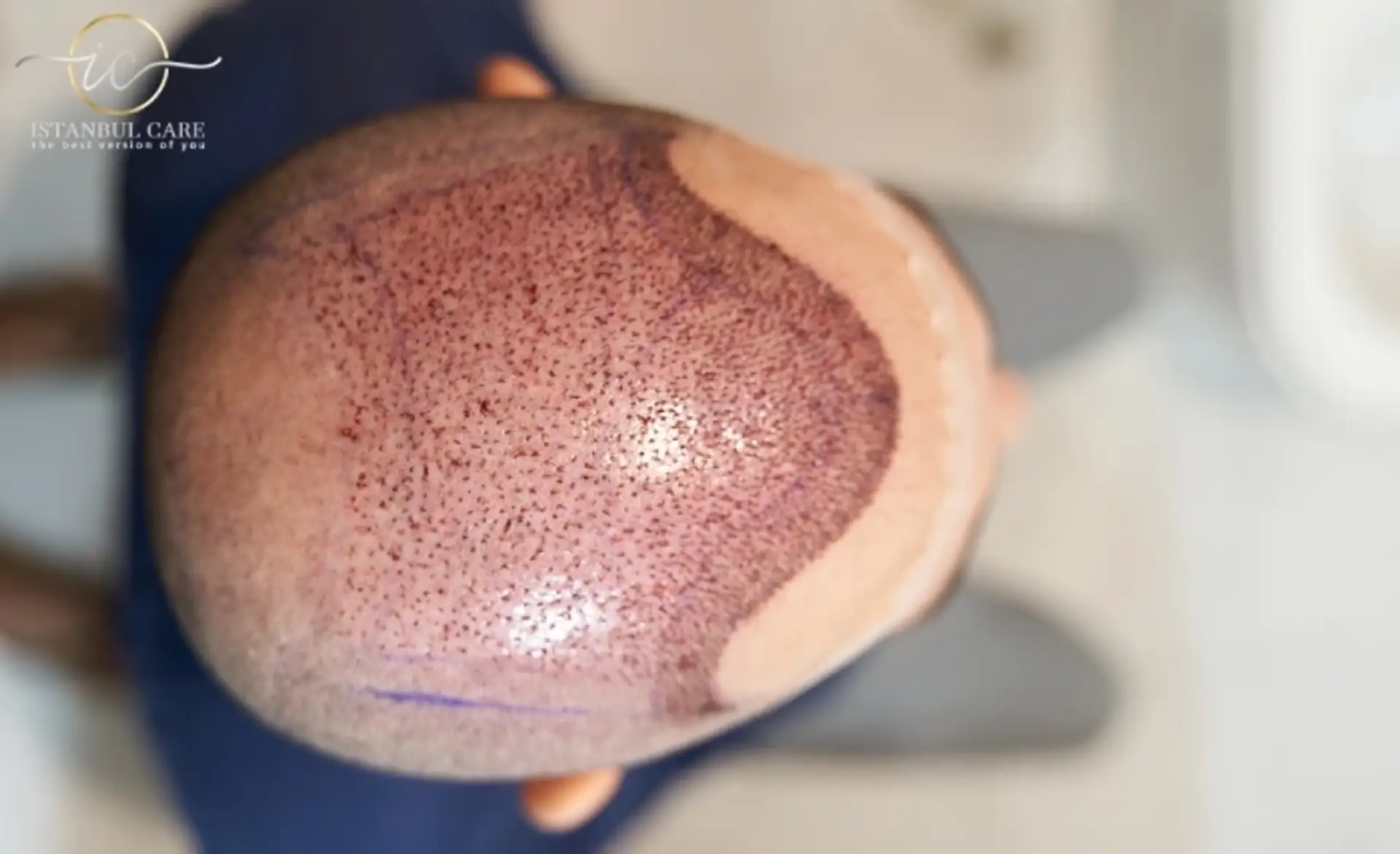 fue hair transplant turkey