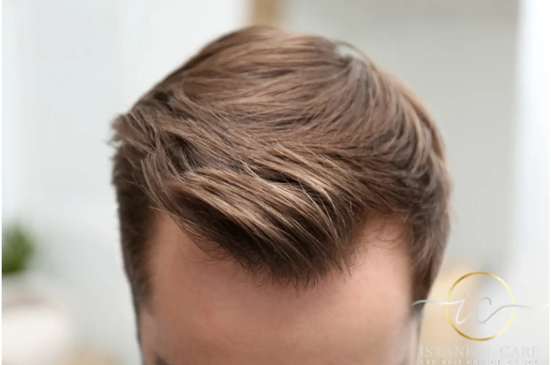 Hair Transplant Before and After Photos
