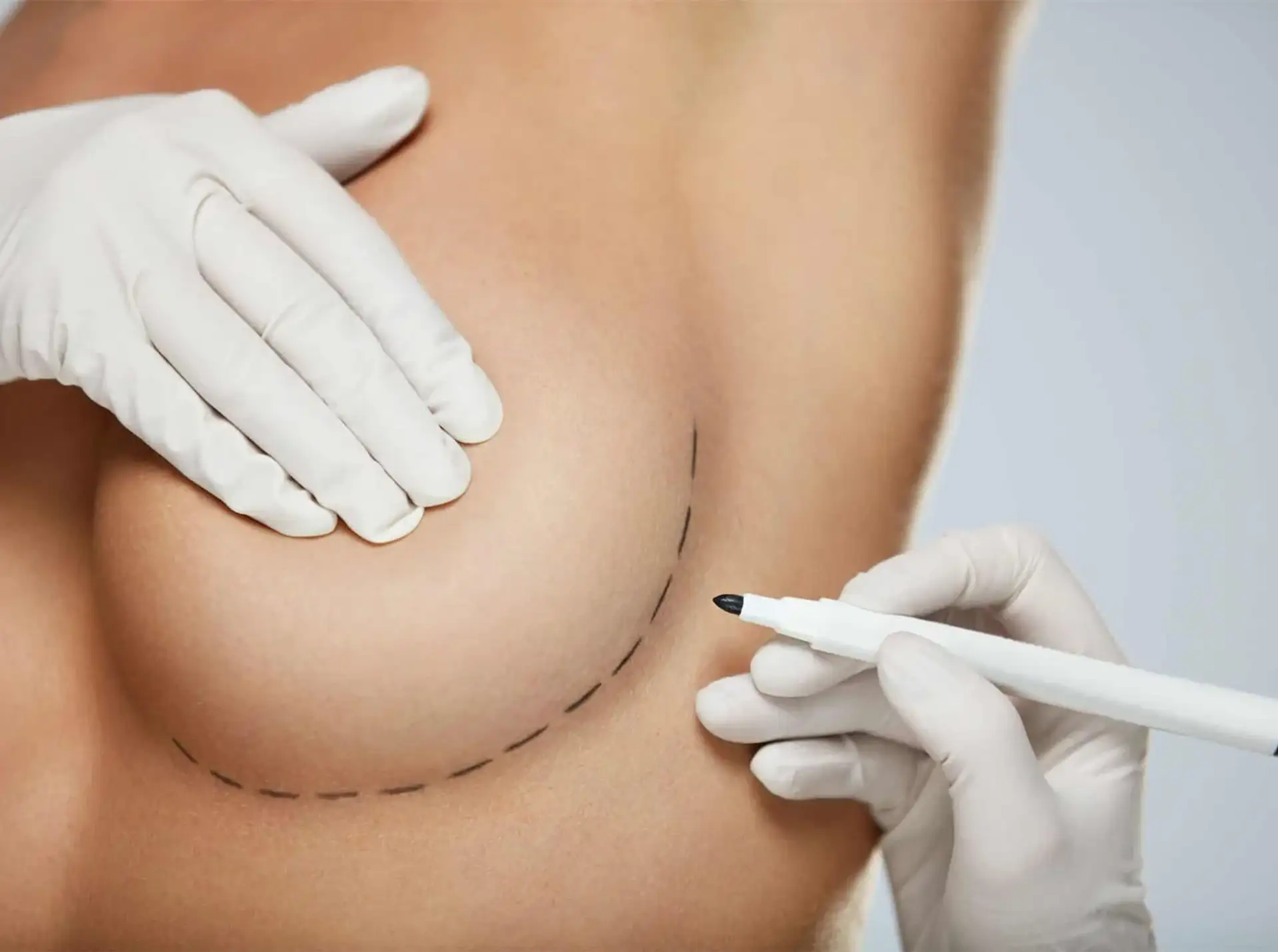 Vertical Incision Breast Reduction