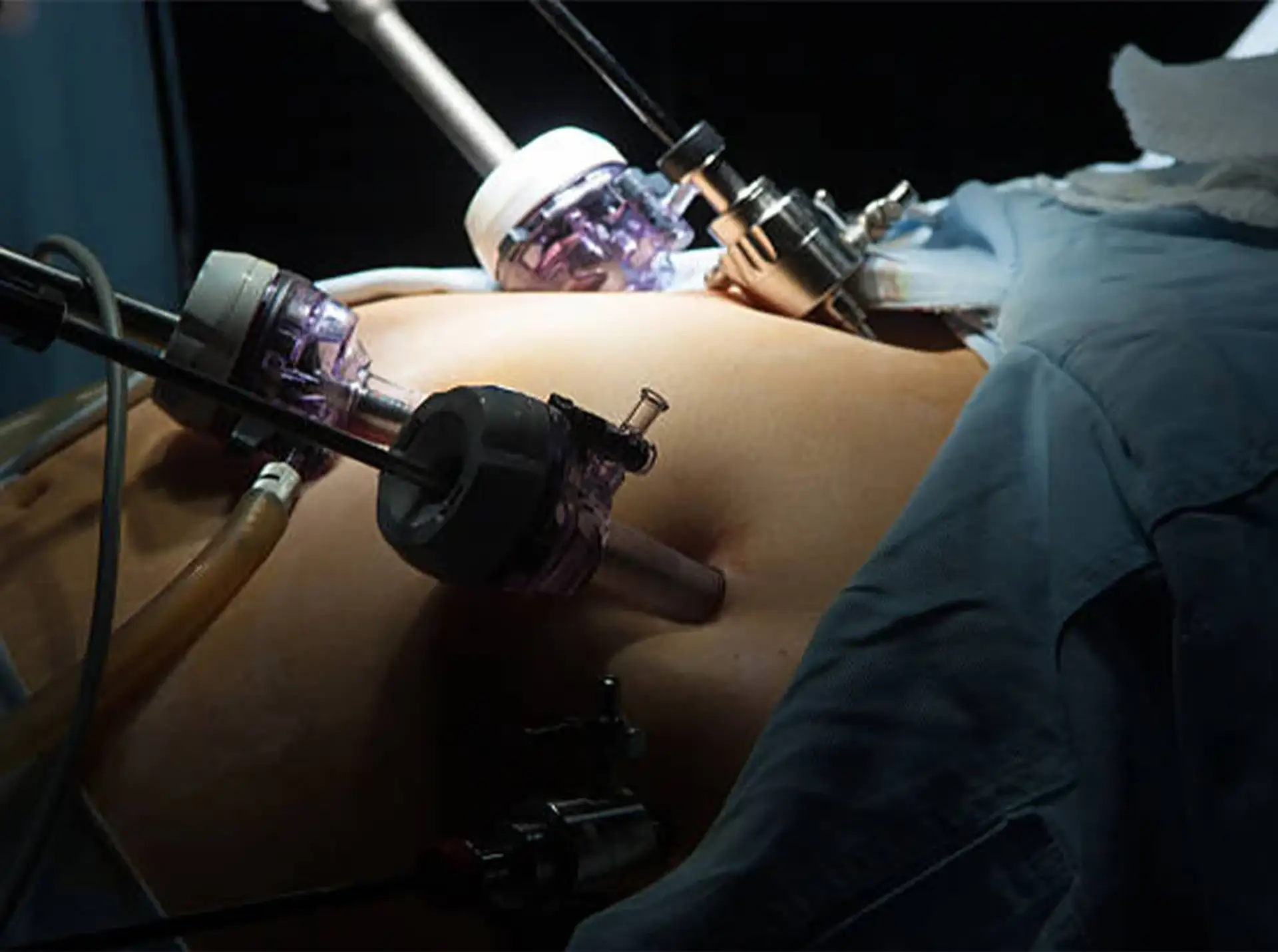 Am I a Suitable Candidate for Gastric Bypass?