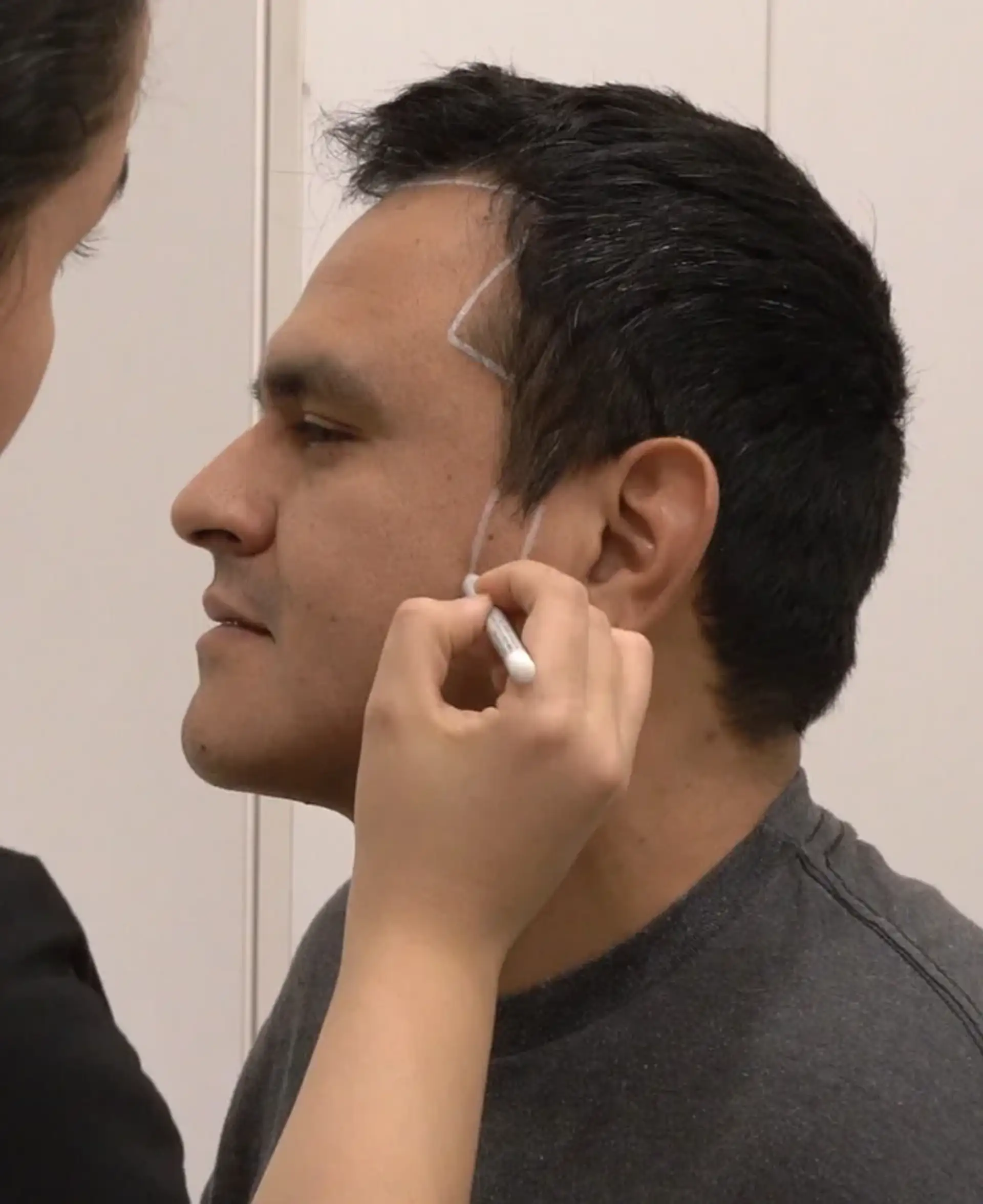 Beard Hair Transplant Consultation in Turkey