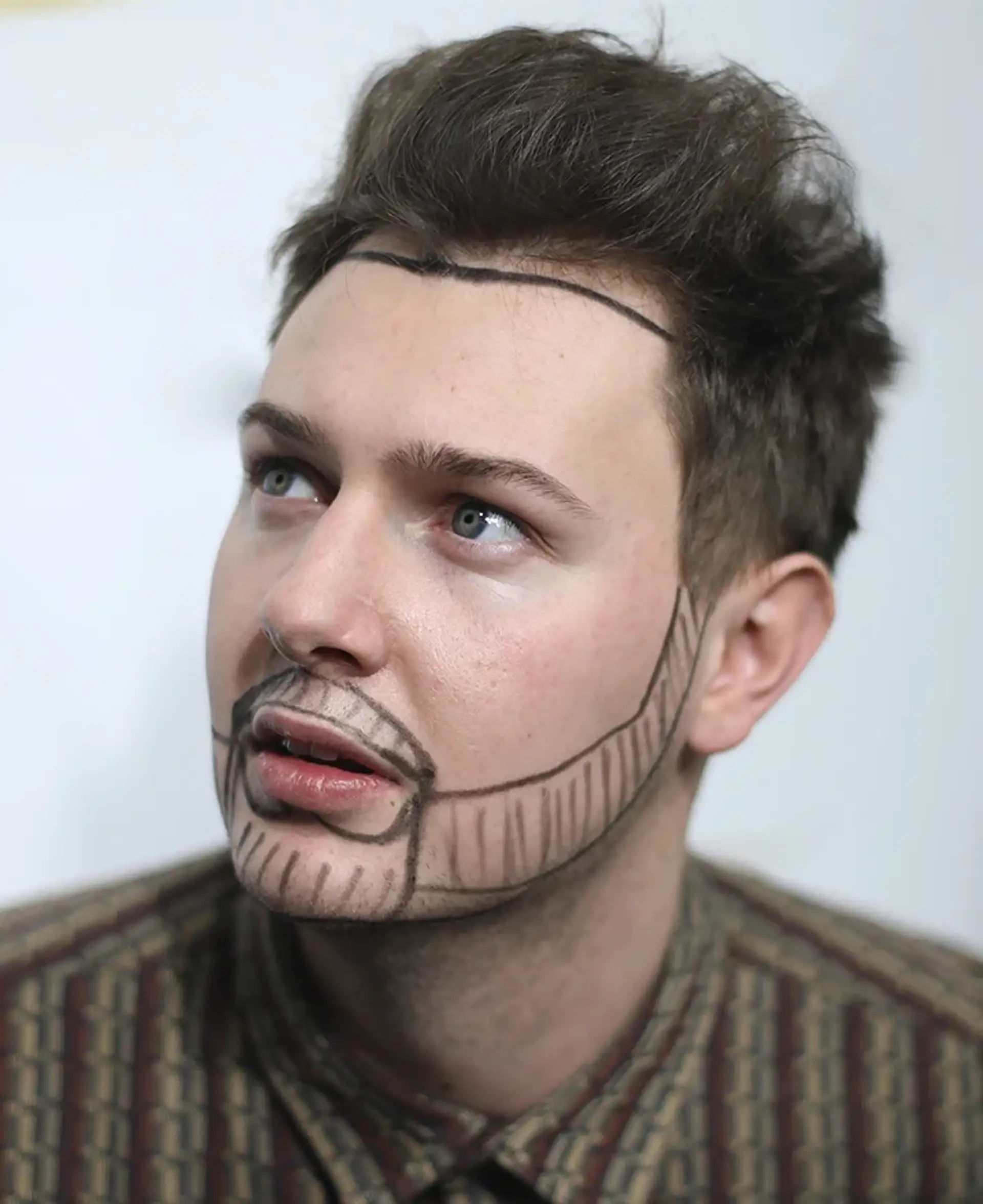 Comfort and Side Effects After a Beard Transplant