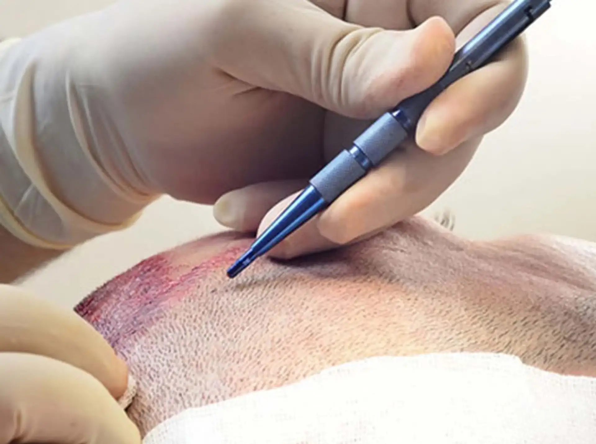 Enjoy Benefits of Sapphire FUE Hair Transplant