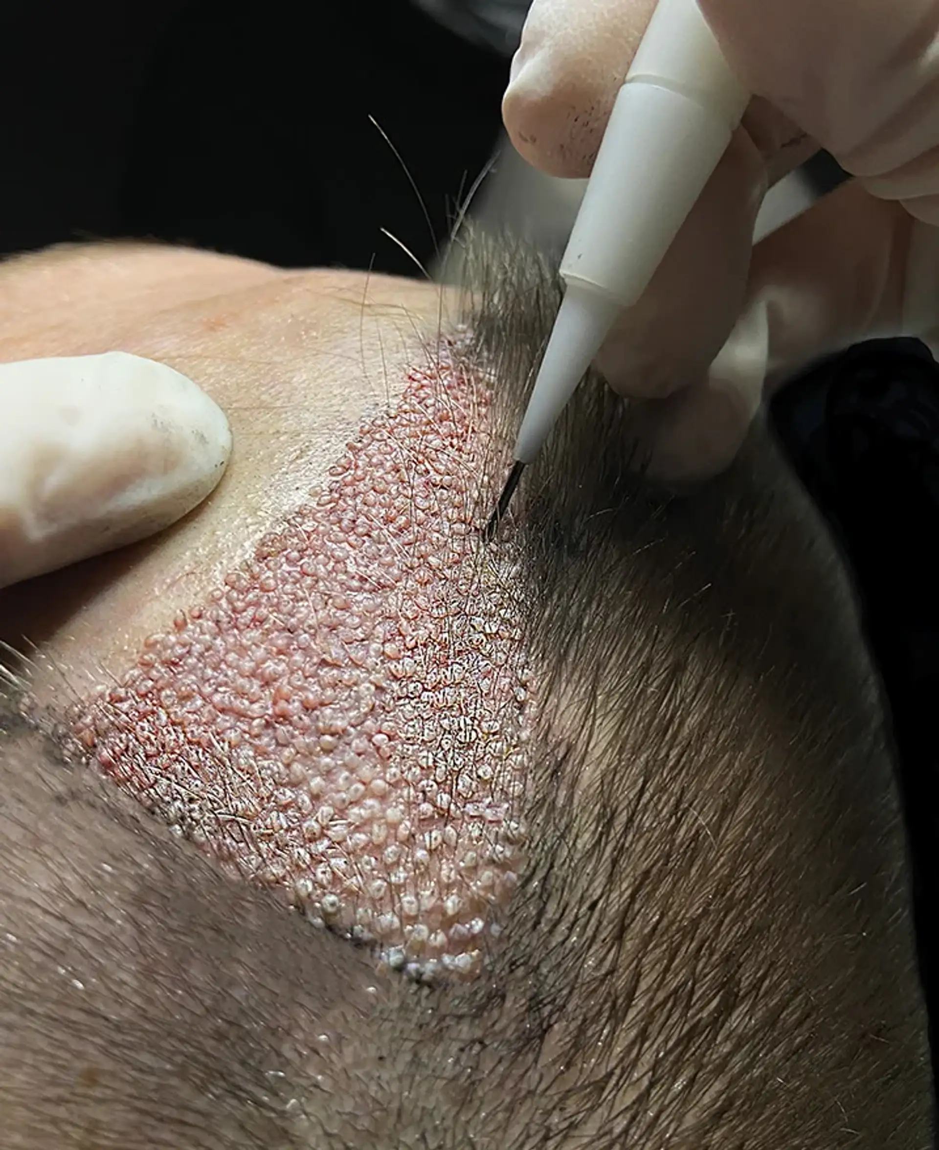 Extracting Healthy Hair Follicles