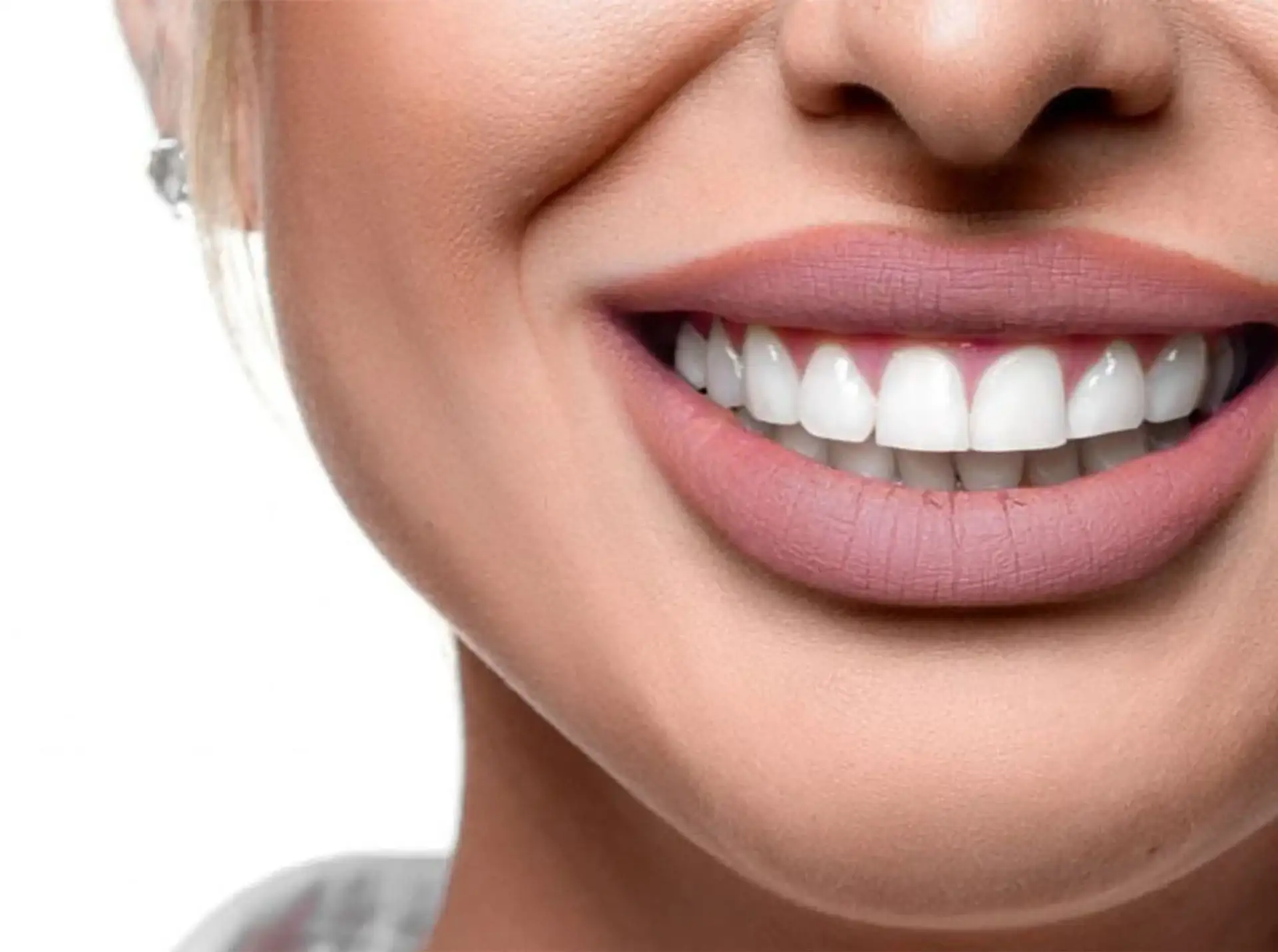 Healing After Veneers