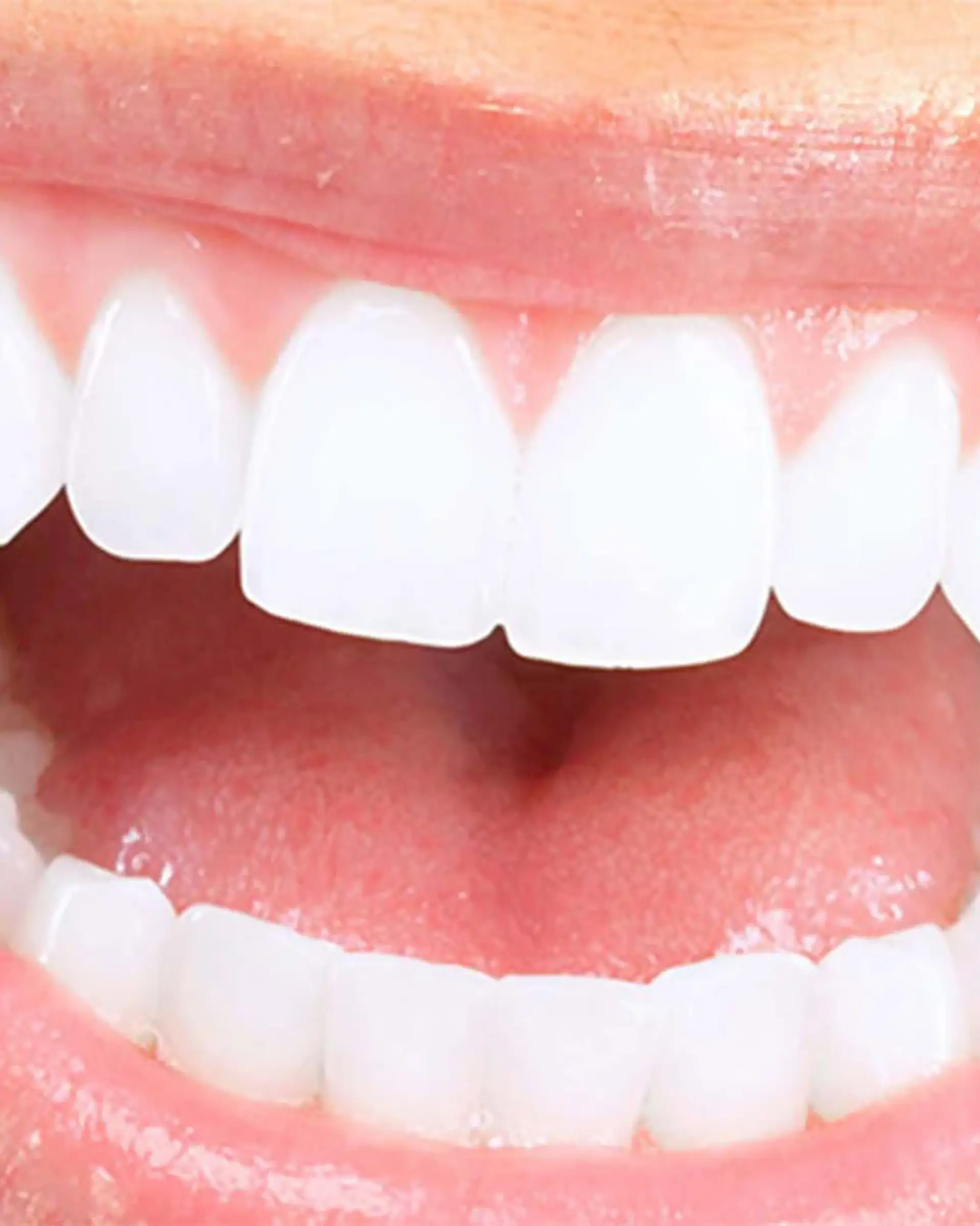 Hollywood Smile Procedure