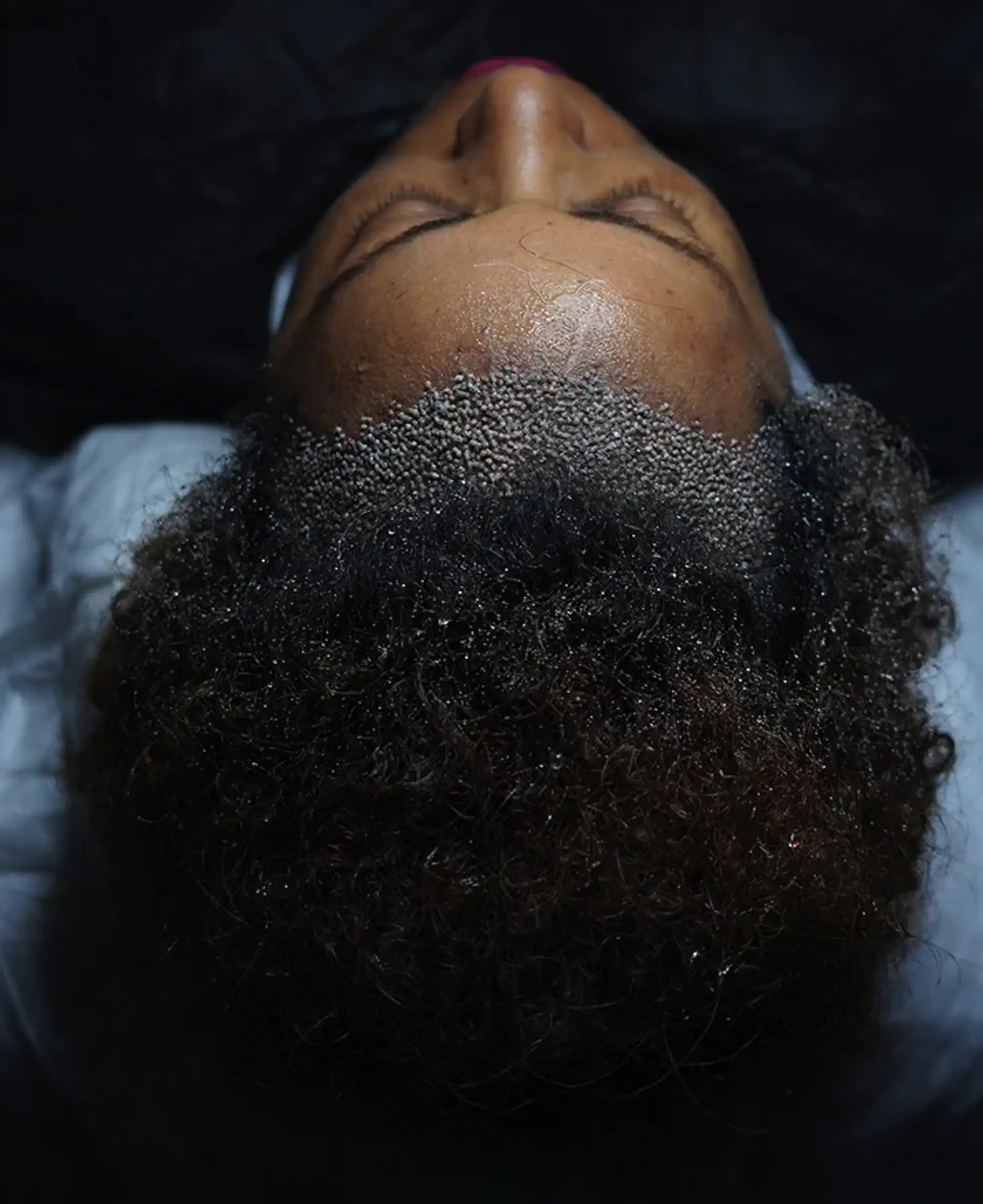 How Long Do Afro Hair Transplant Results Last