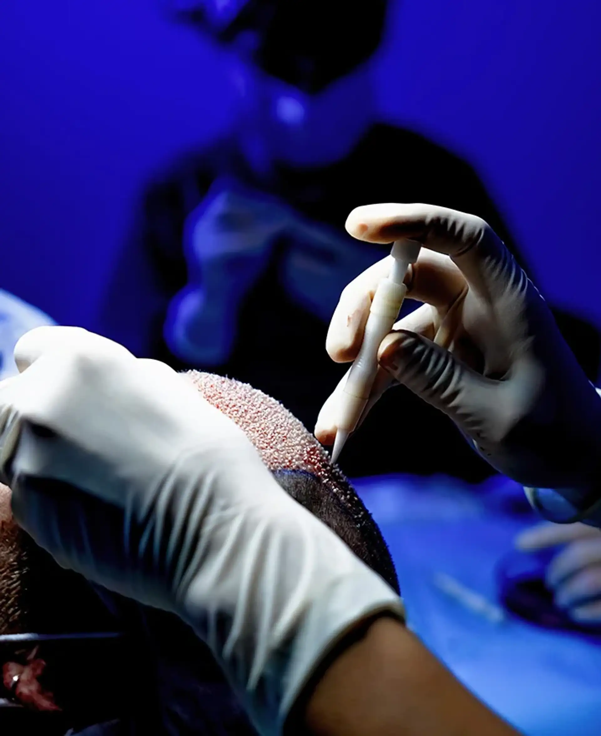 How the DHI method differs from traditional hair transplant
