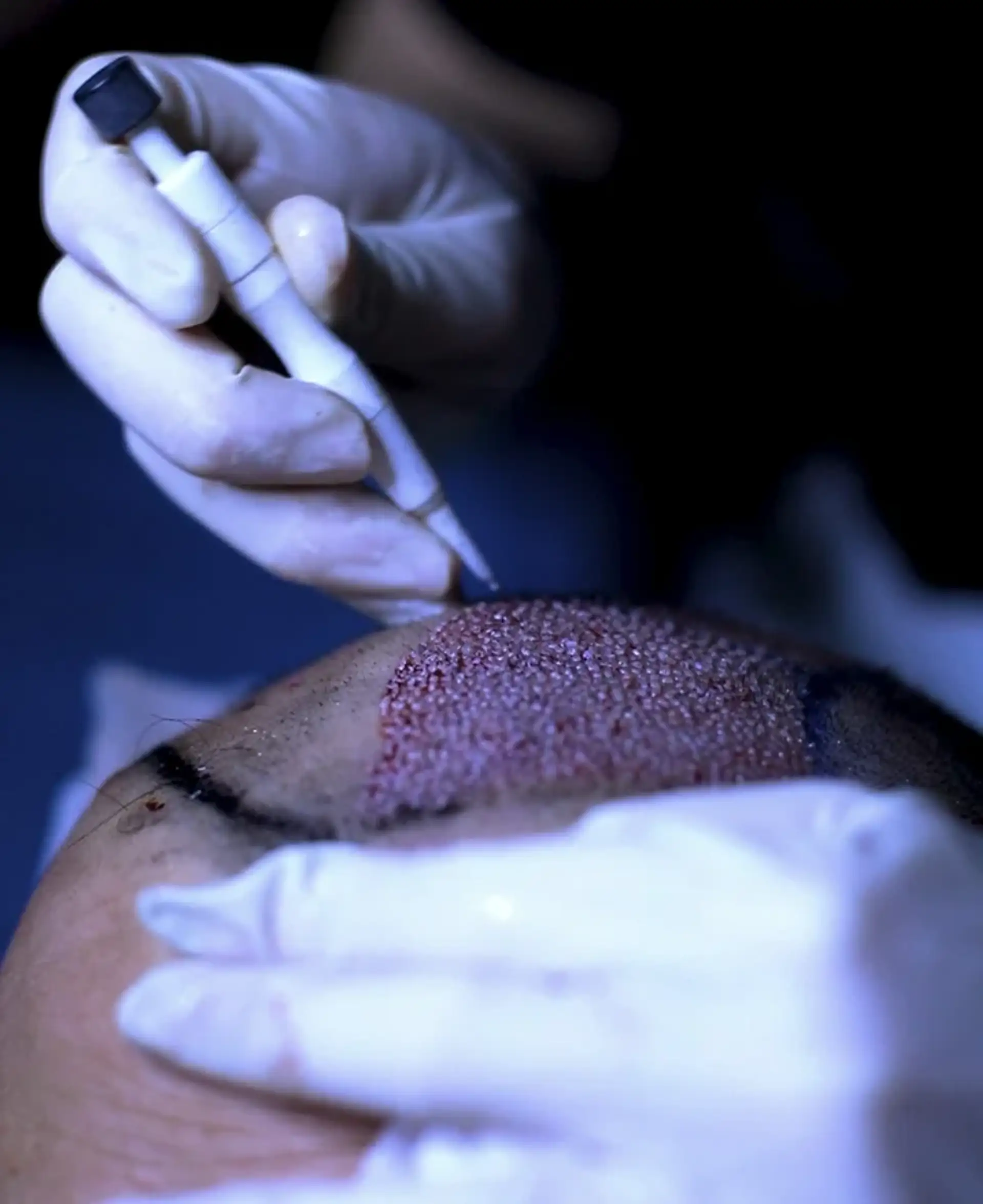 Low Chance of Infection or Bleeding