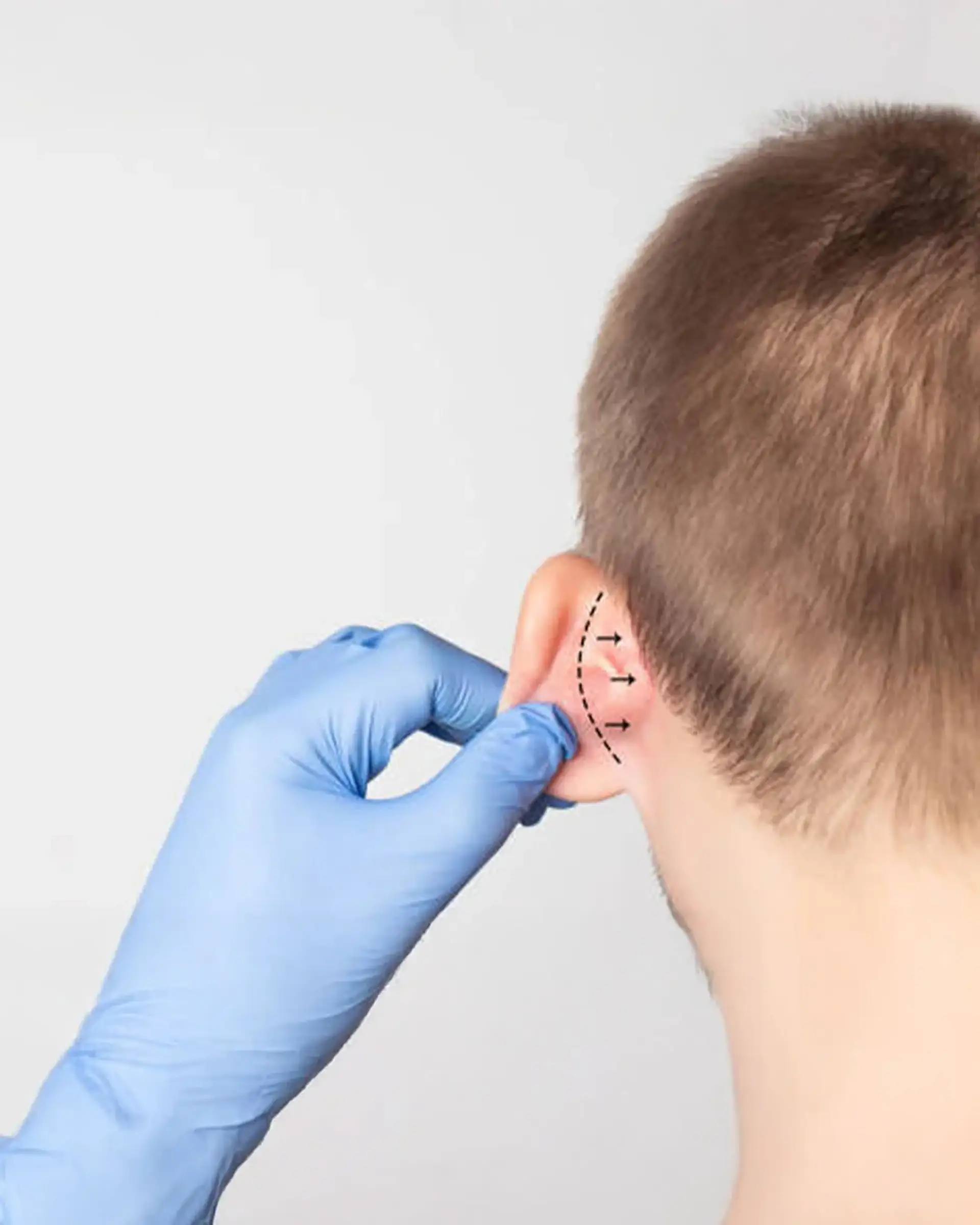 Otoplasty Recovery Time