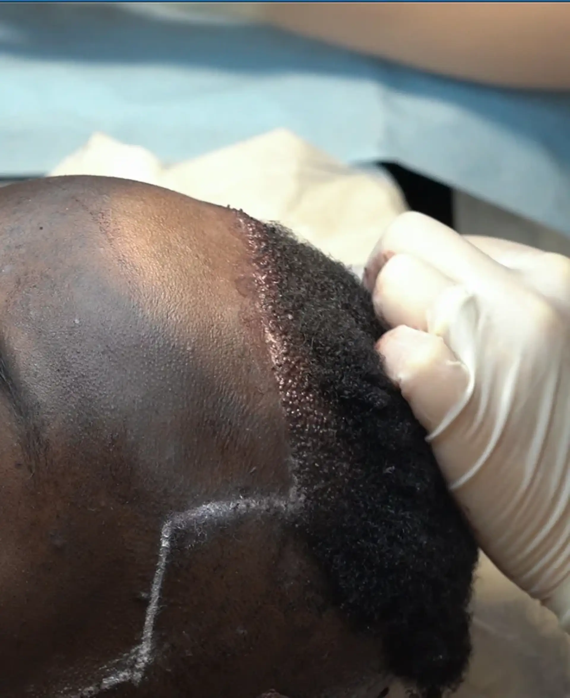 Patient Experience from Pre Op to Full Growth