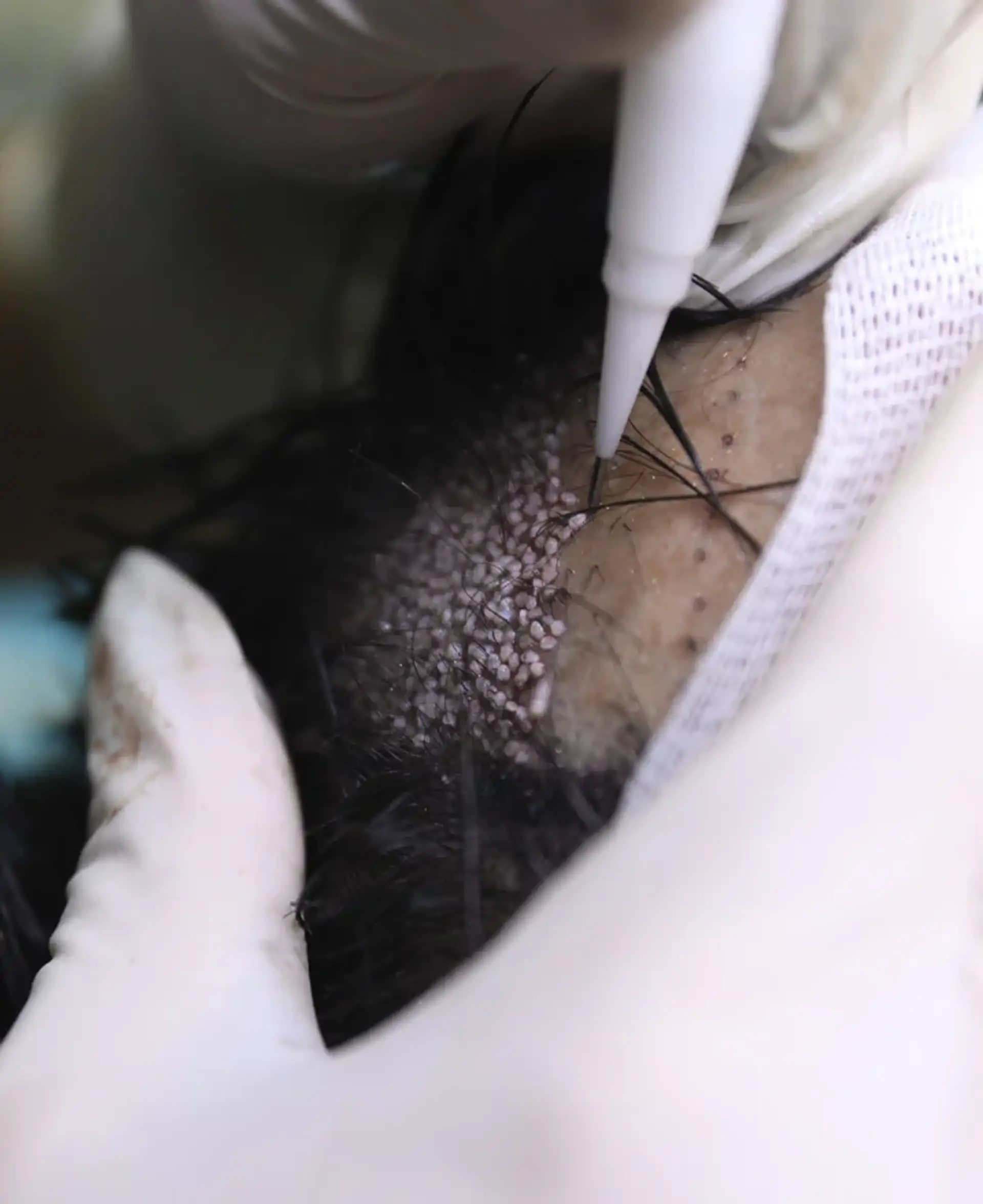 Placing Grafts for Natural Density