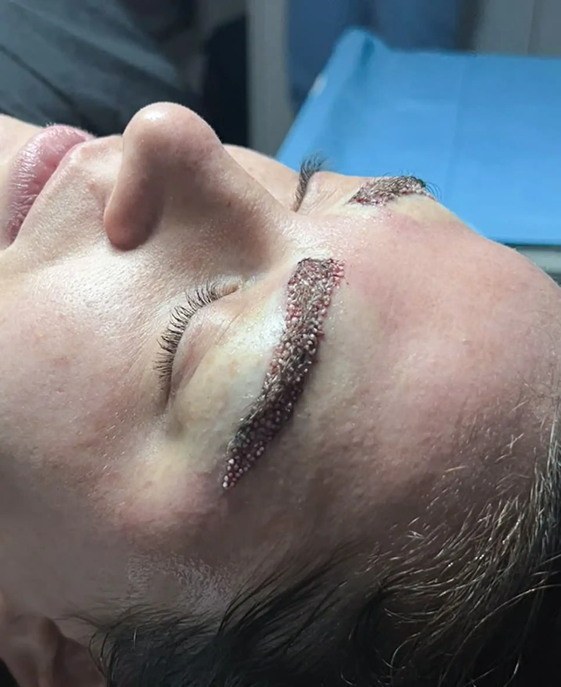 Precise Graft Placement for Natural Growth Pattern