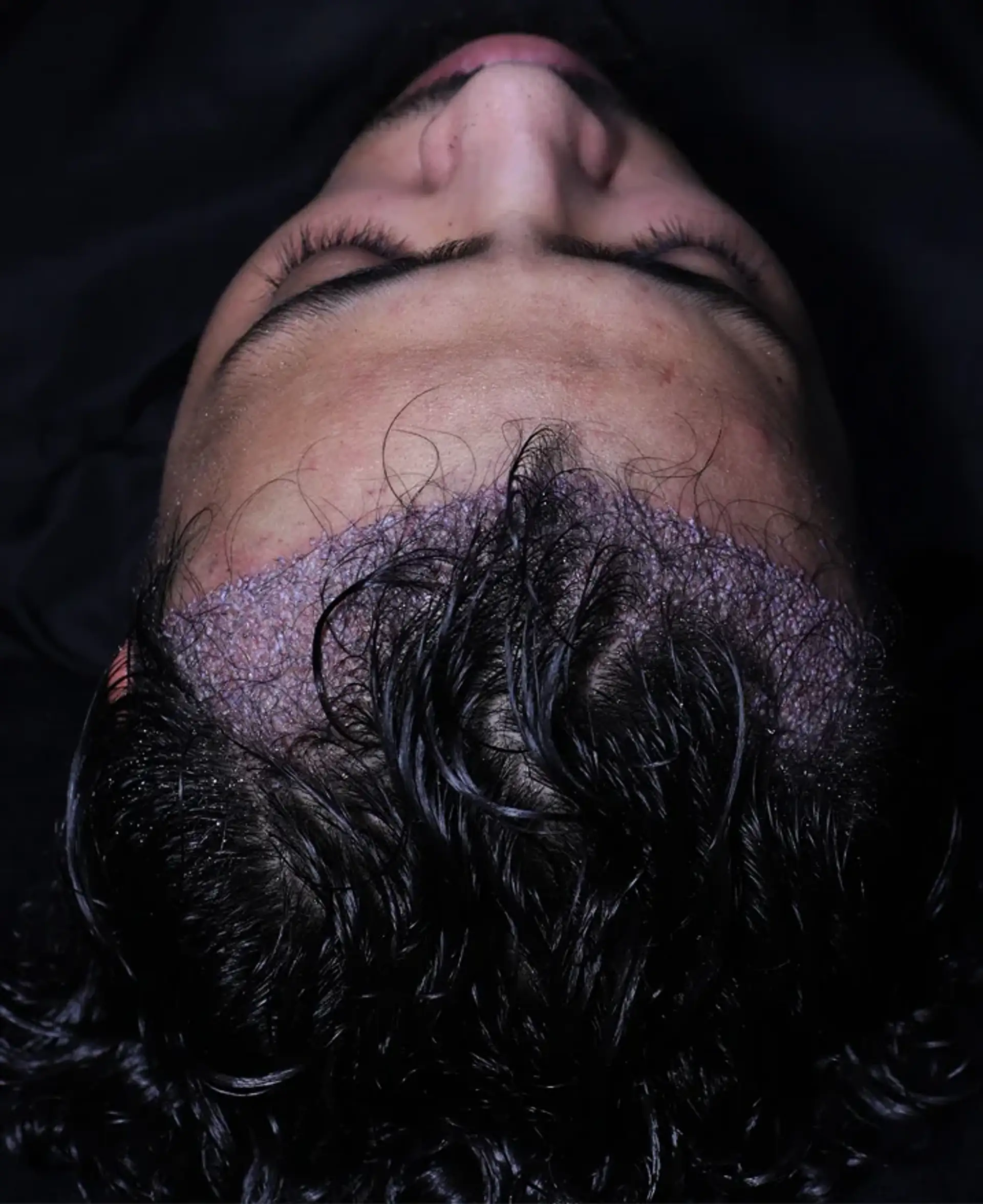 Recovery timeline after your DHI hair transplant