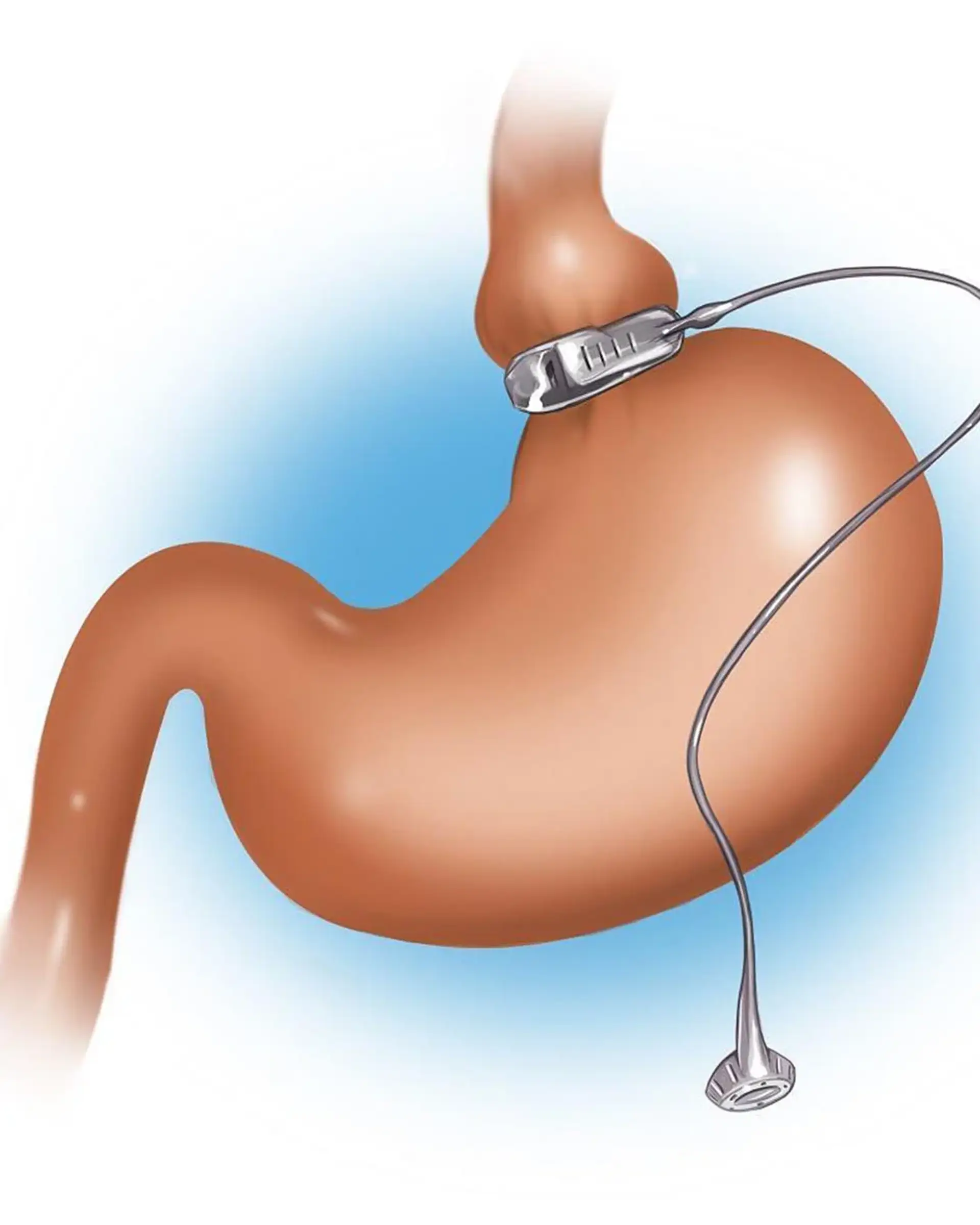 The LAP-BAND System Advantage