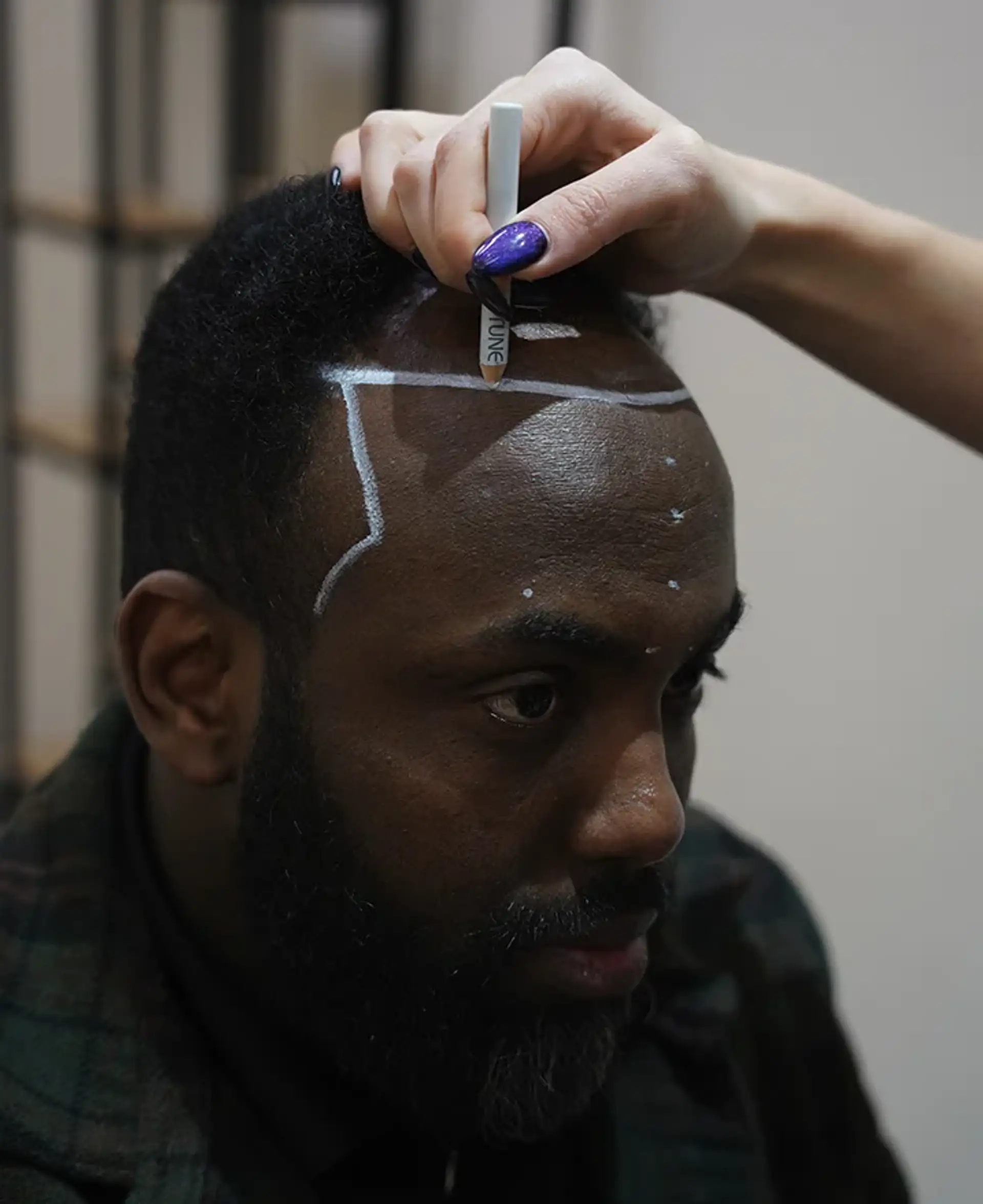 Treating Male Pattern Baldness in Afro Hair