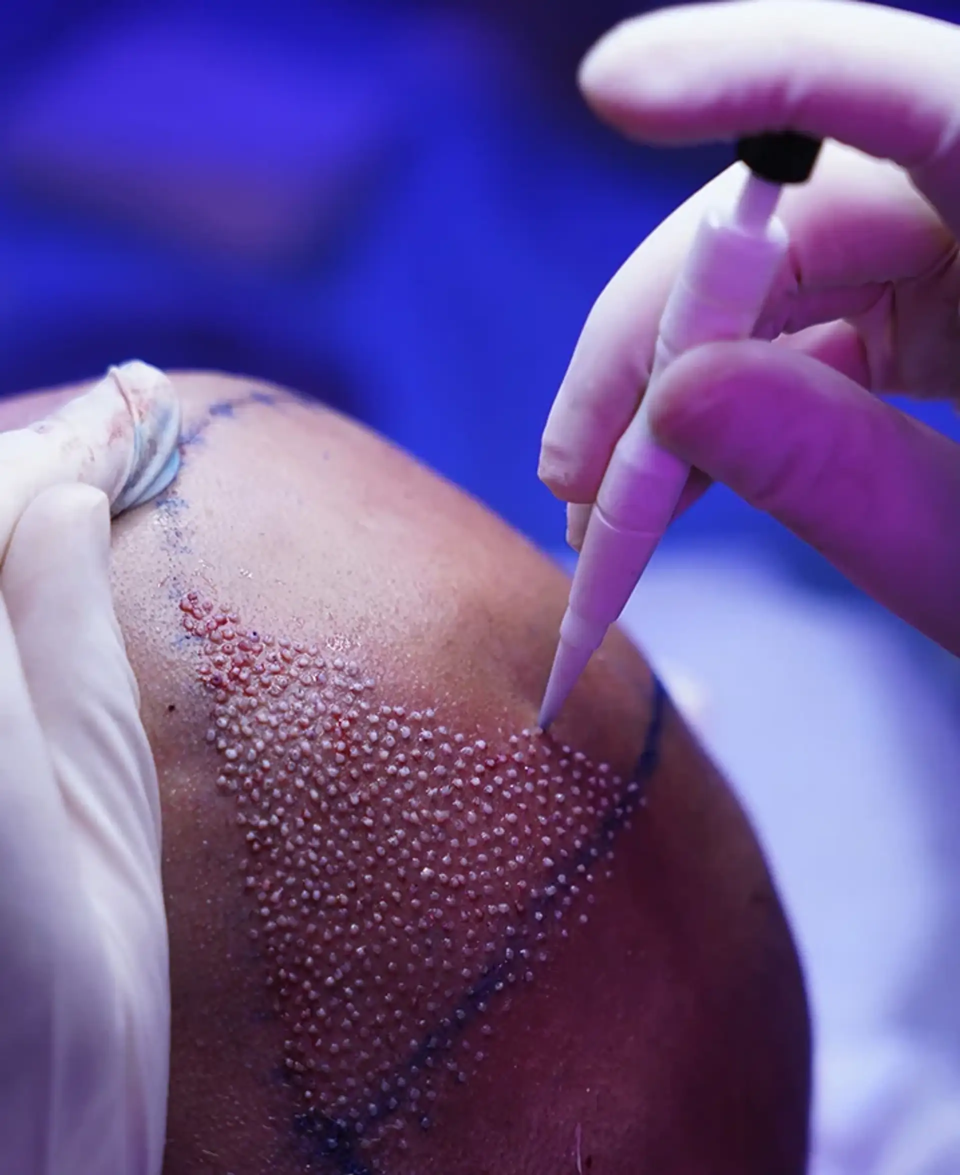 Understanding direct hair implantation technique