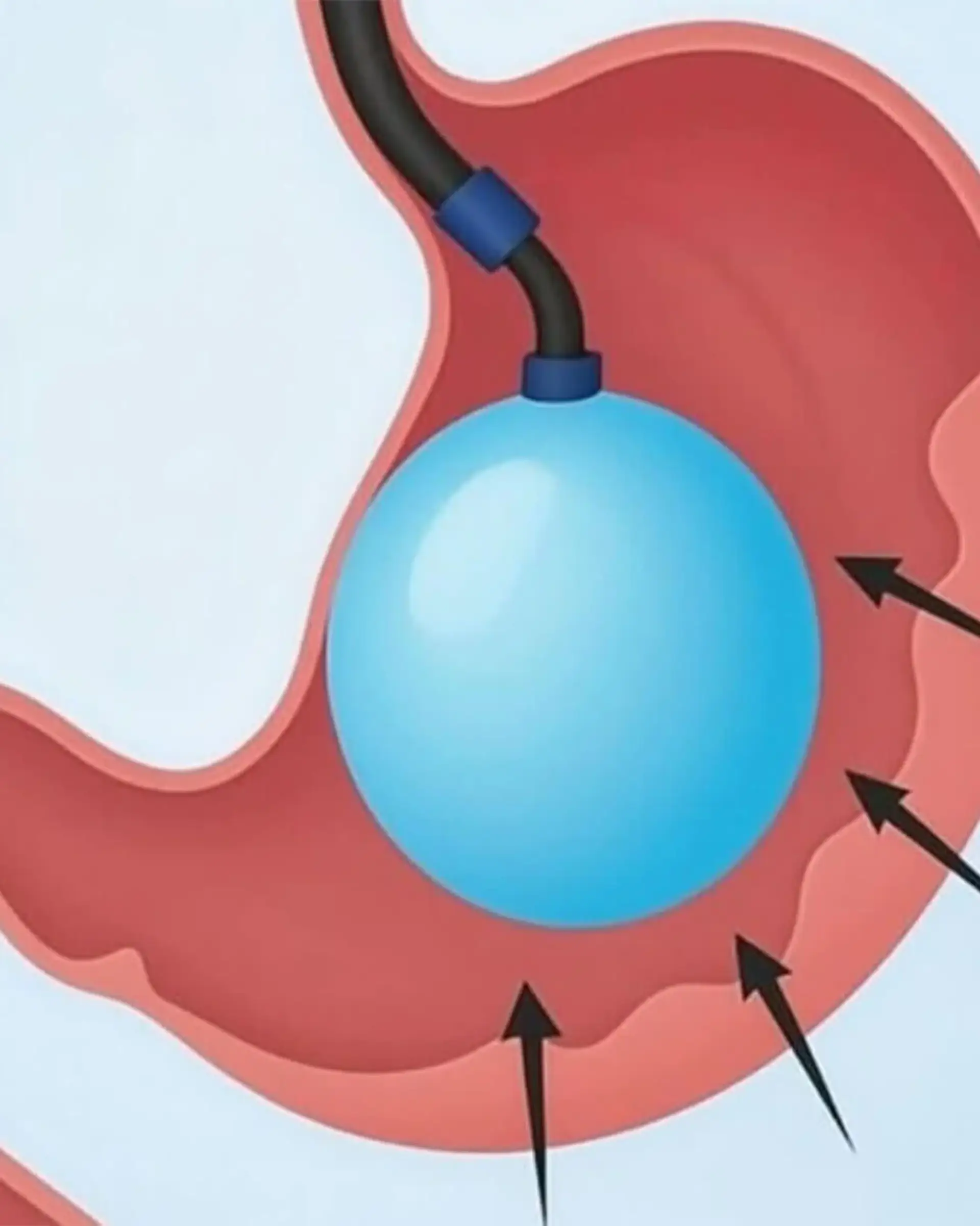 What Happens After the Procedure?