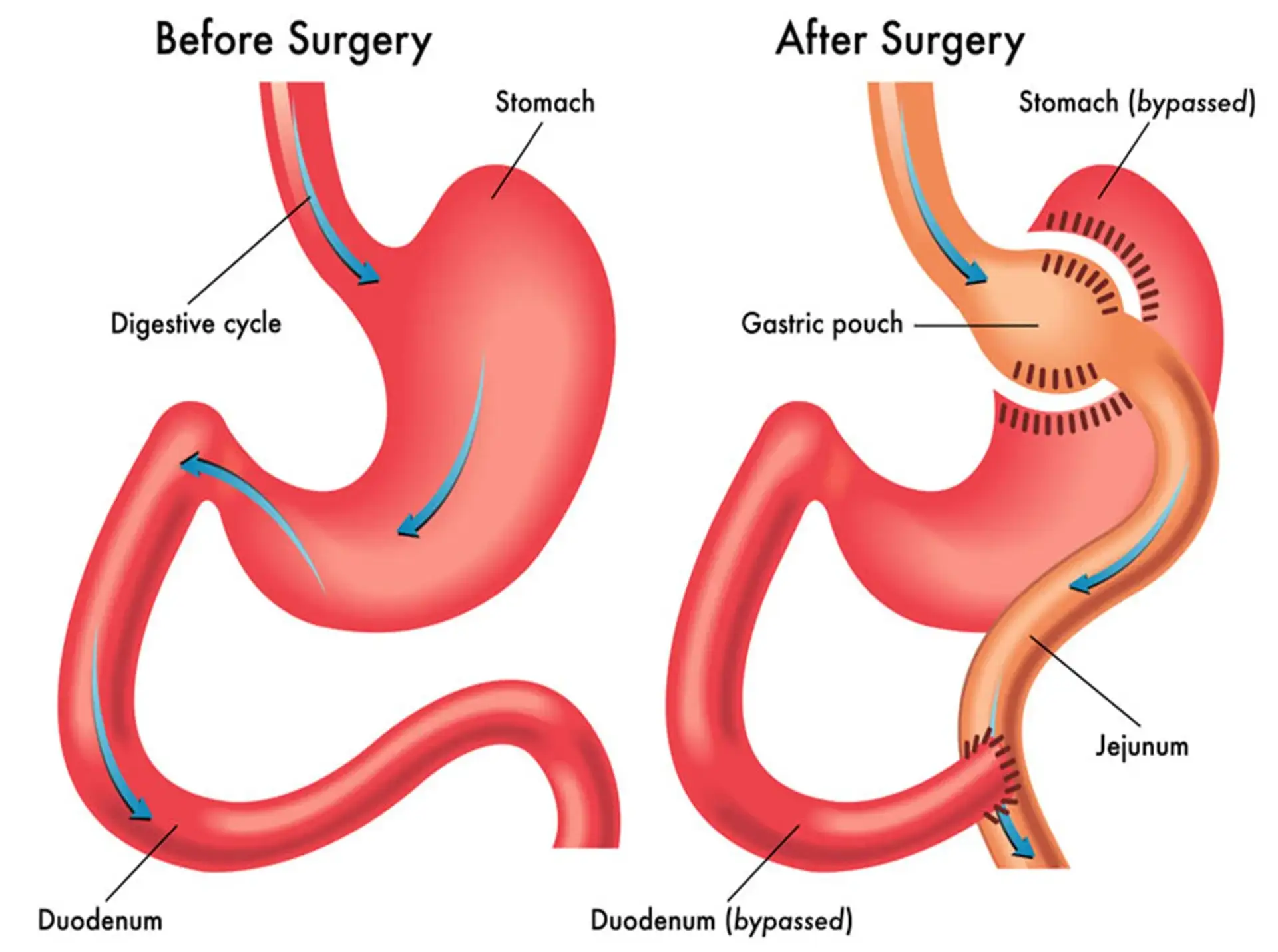 What Is Gastric Bypass Surgery?