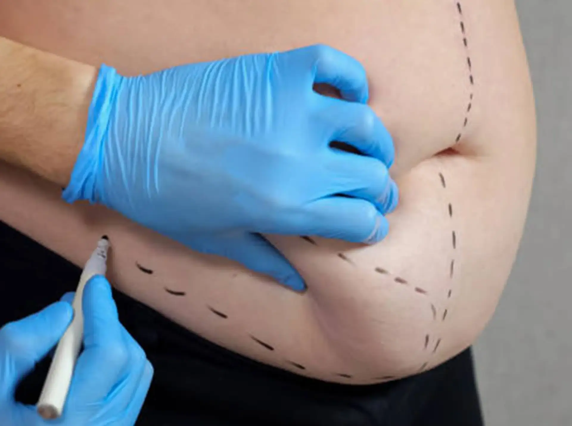 What’s the First Step at Liposuction in Turkey?