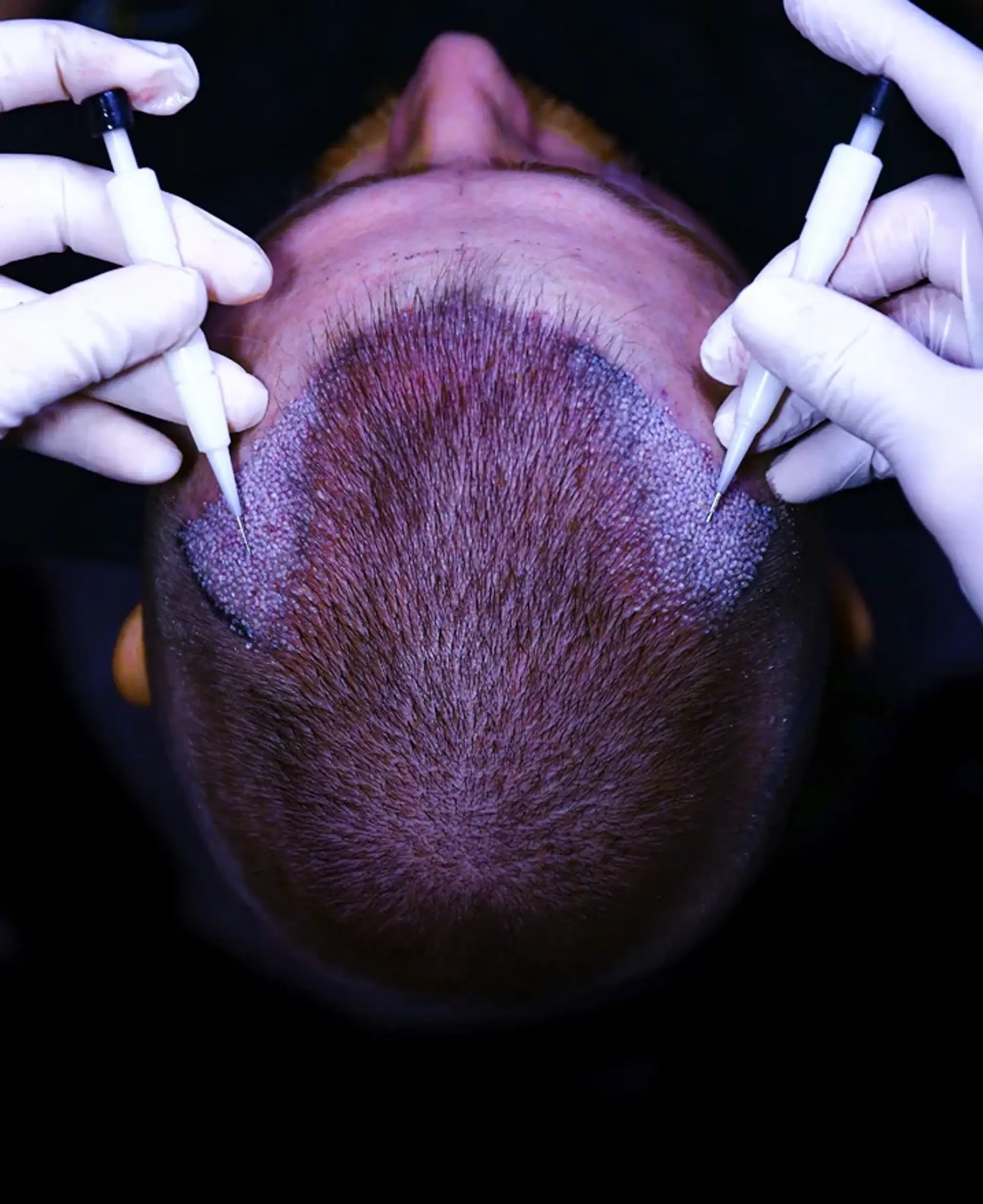 Why the no-shave option appeals to many patients