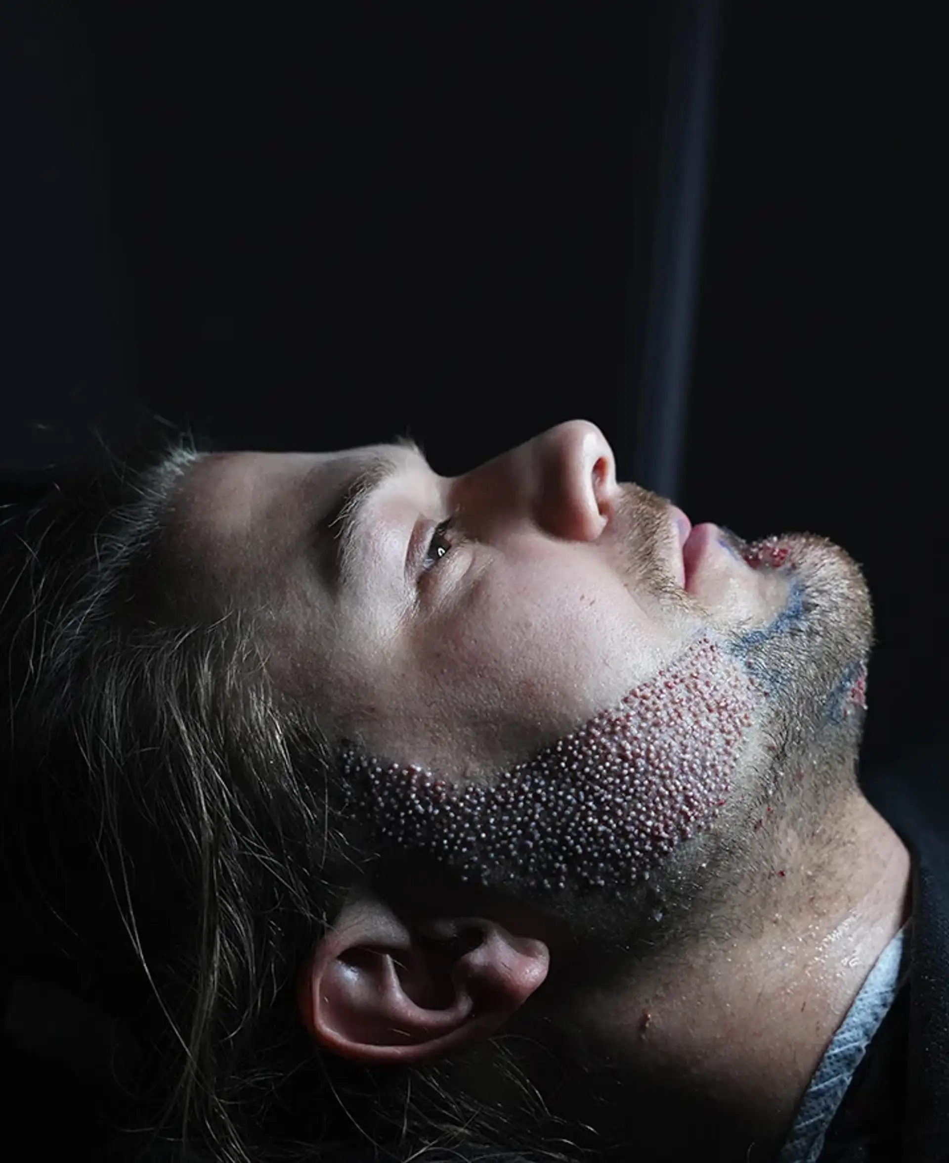 style beard transplant patient guidance